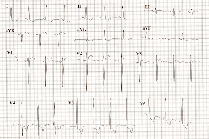 Casos clínicos electrocardiográficos razonados