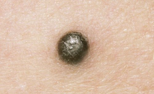 Nódulo Melanoma Metastásico