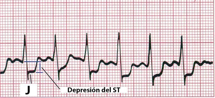 Isquemia en el ECG