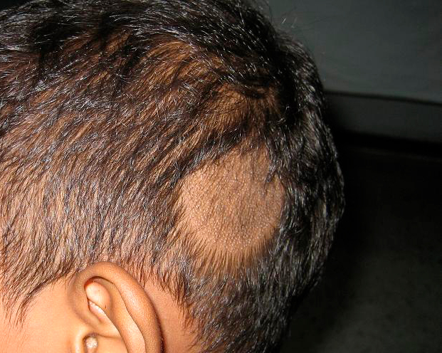 Tinea capitis