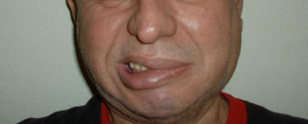 Accidente cerebrovascular