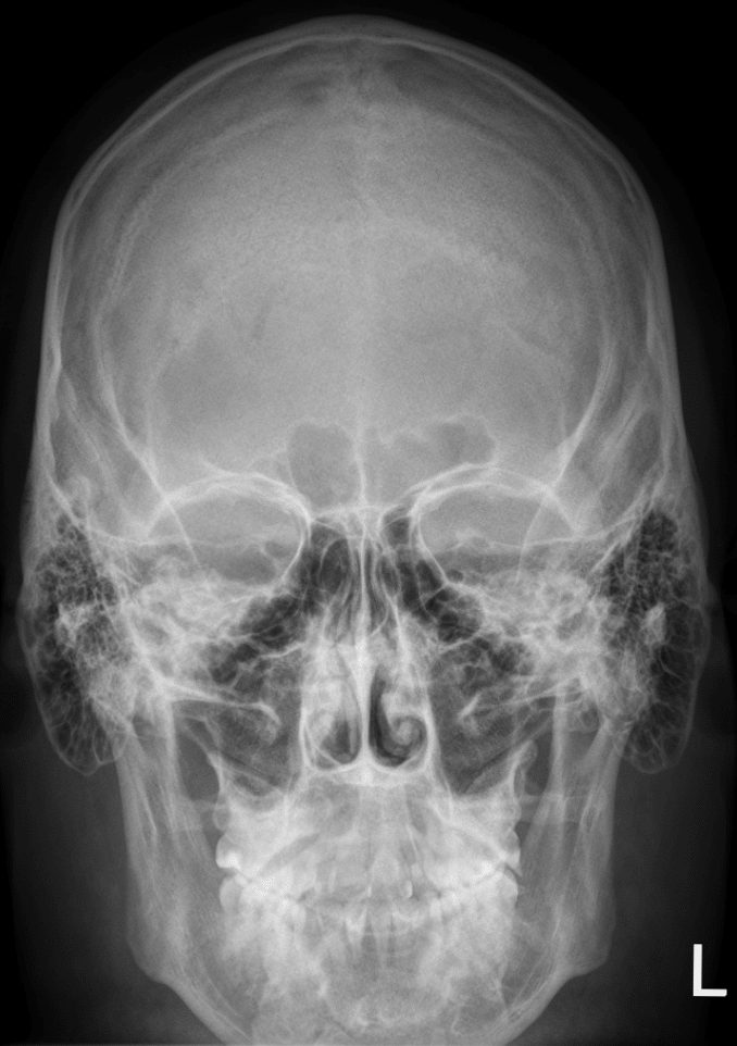 AP de cráneo en el traumatismo craneofacial.