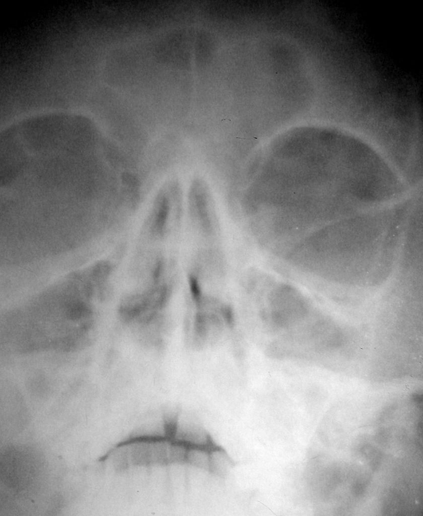 Proyección de Caldwell en el traumatismo craneofacial.