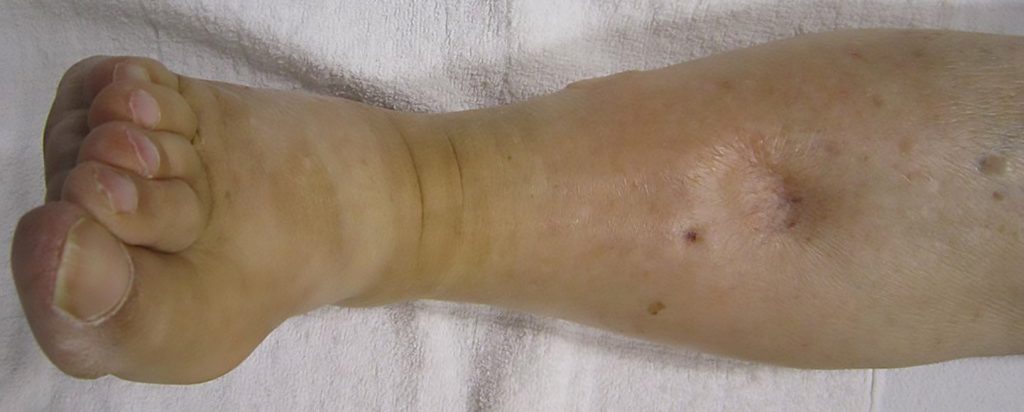 Edema