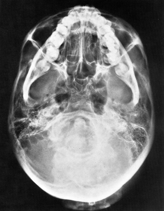 Proyección de Hirtz en el traumatismo craneofacial.