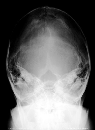 Proyección de Towne en el traumatismo craneofacial.