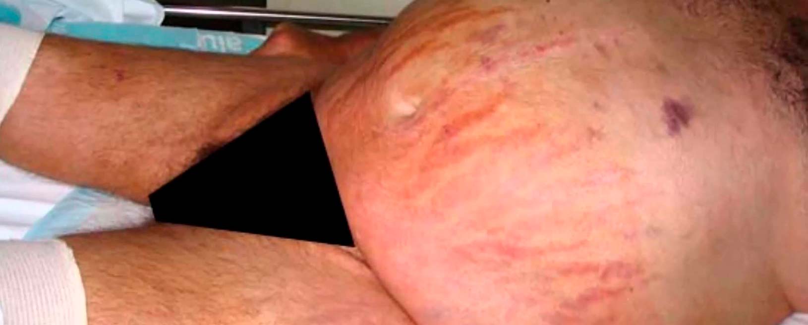 sindrome de cushing