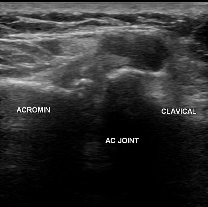 Artrosis acromioclavicular
