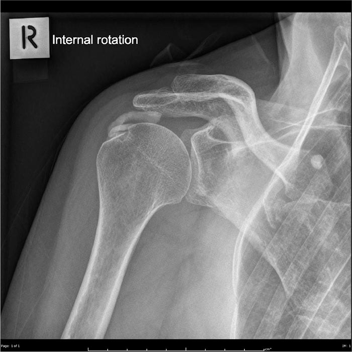Tendinitis calcificada