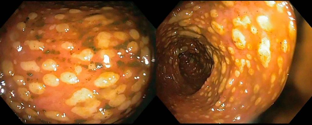 Colitis Pseudomembranosa