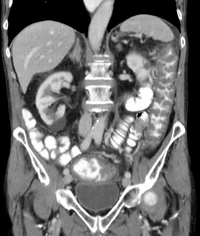 Colitis Pseudomembranosa en TAC