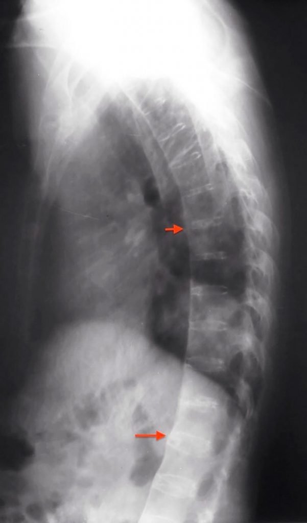 Espondilitis Anquilosante
