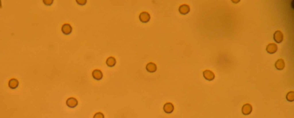 Hematuria, leucocituria, cilindros, sedimento urinario