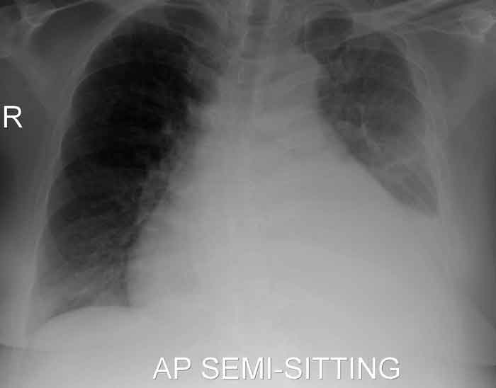 Hemopericardio