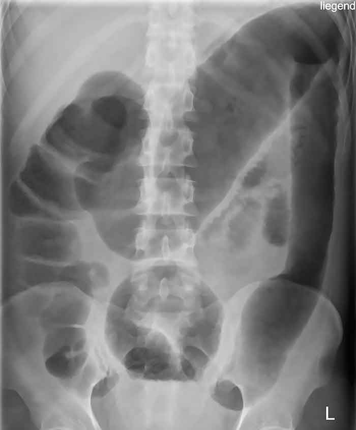 Megacolon tóxico