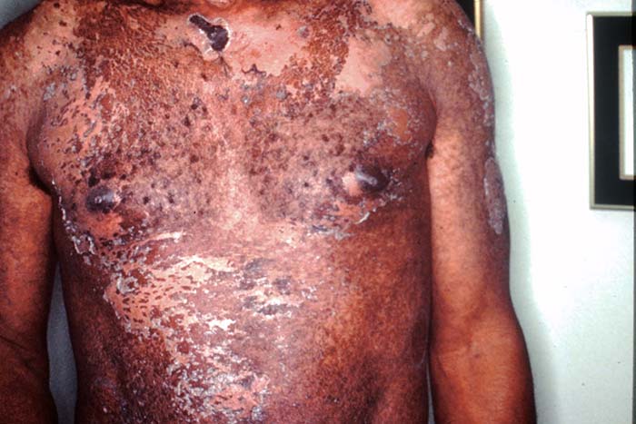 Necrolisis epidérmica tóxica