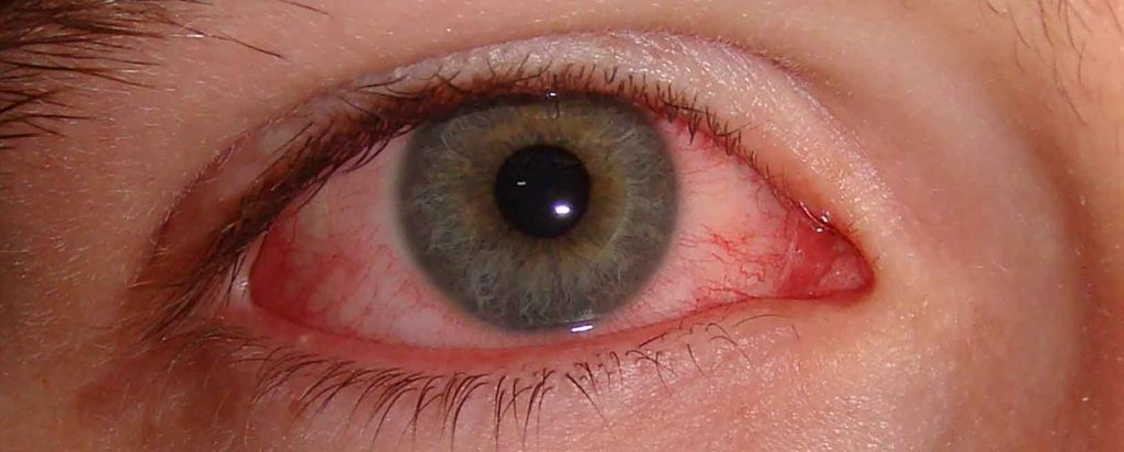 Ojo rojo