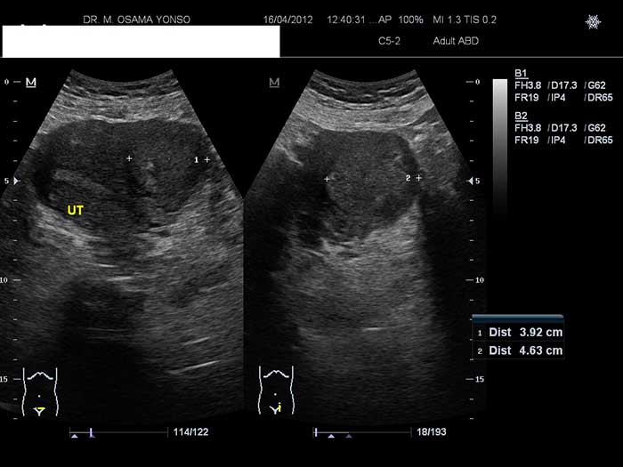 Mioma Uterino en US