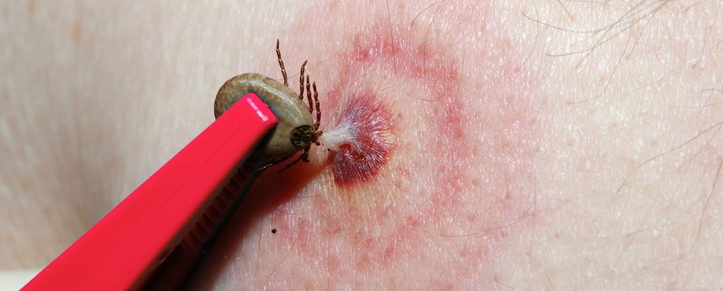 Rickettsiosis, anaplasmosis y ehrlichiosis