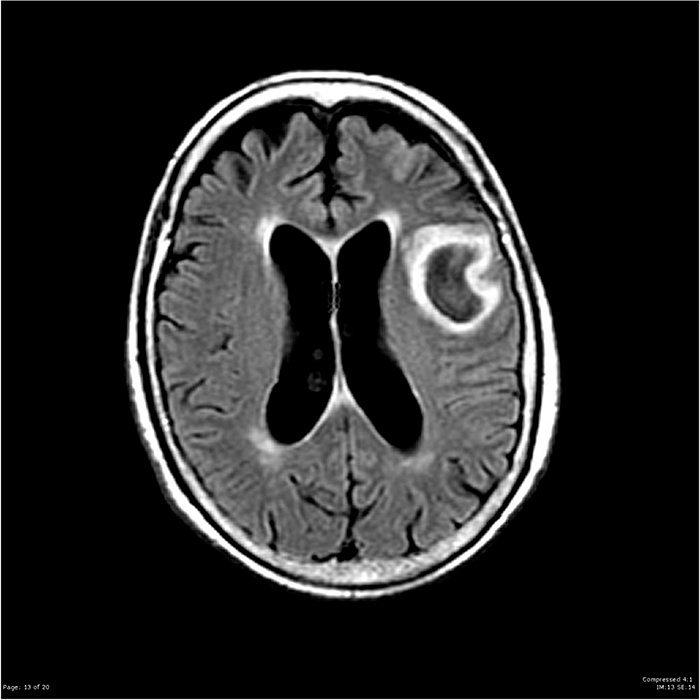 Absceso Cerebral