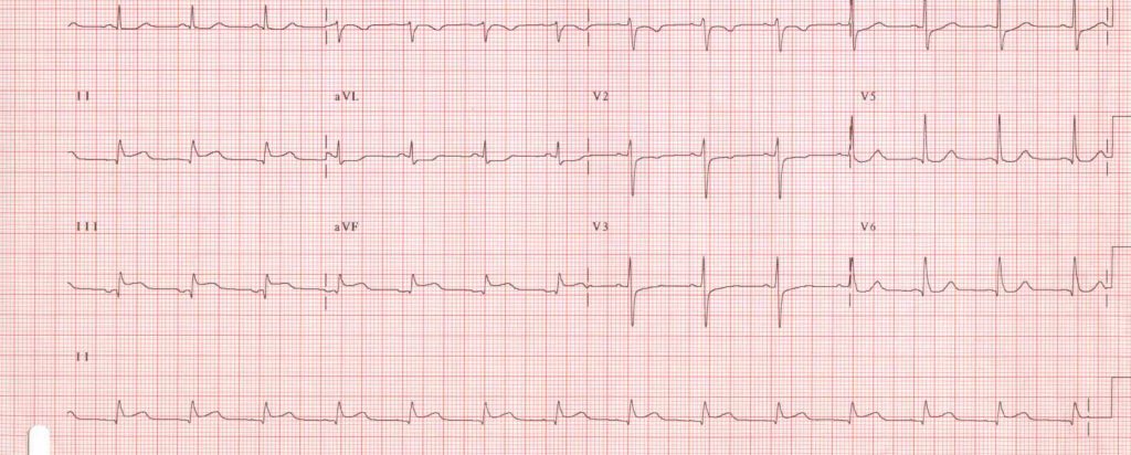 Infarto del Miocardio