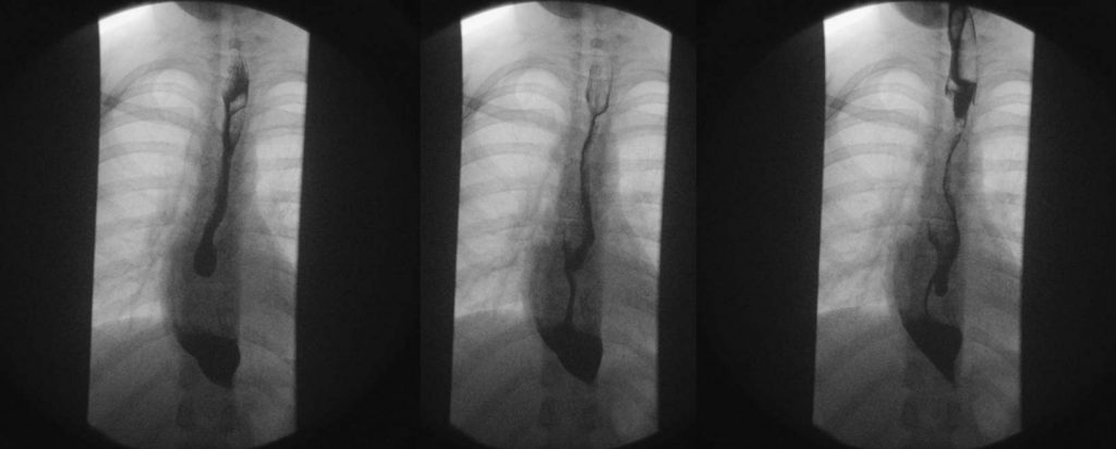 Disfagia Esofágica Muscular Continua y Acalasia Cricofaríngea.