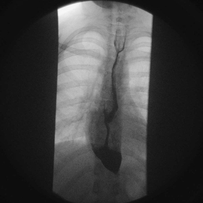 Acalasia en serie esofagogastroduodenal