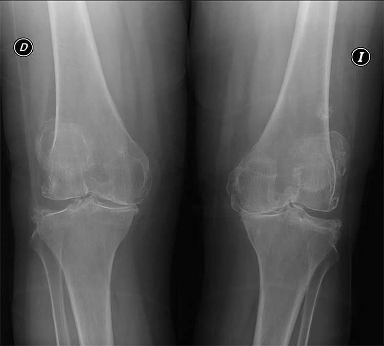 Gonartrosis bilateral de rodilla