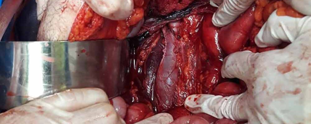 Cirugía del Trauma Abdominal