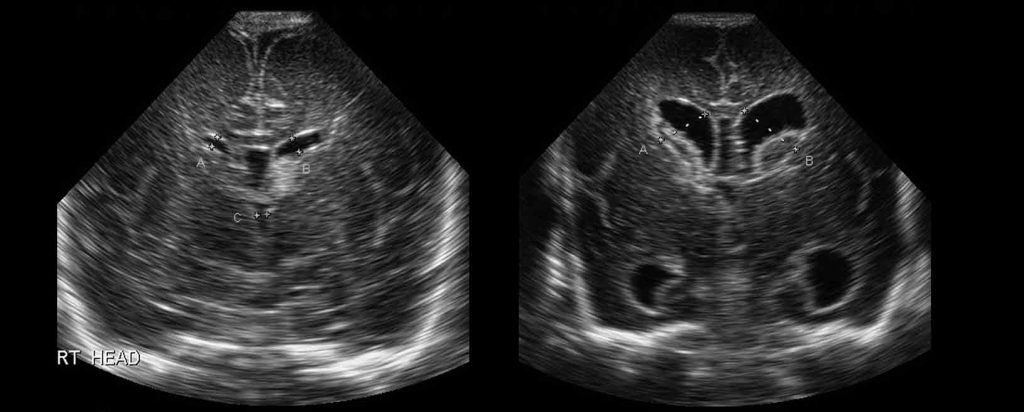 Hemorragia de la matriz germinal y hemorragia intraventricular