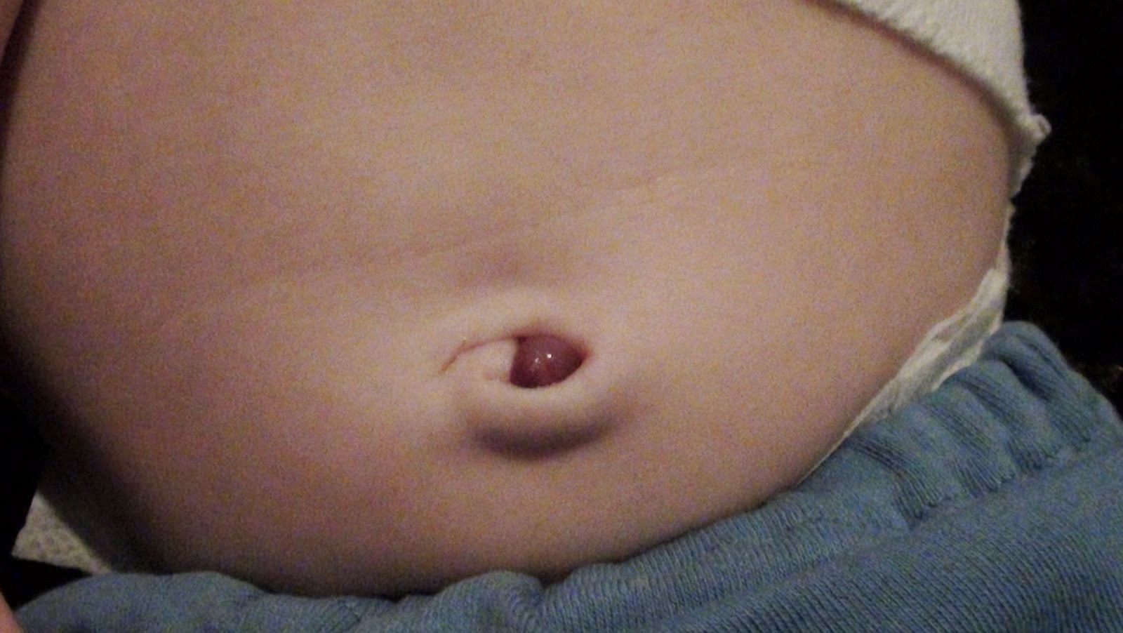 Granuloma Umbilical