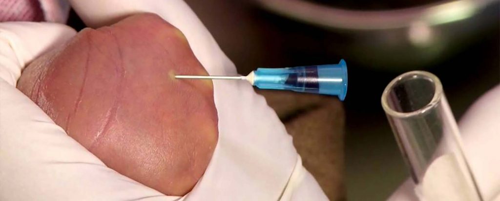 Anemia del Prematuro y Policitemia