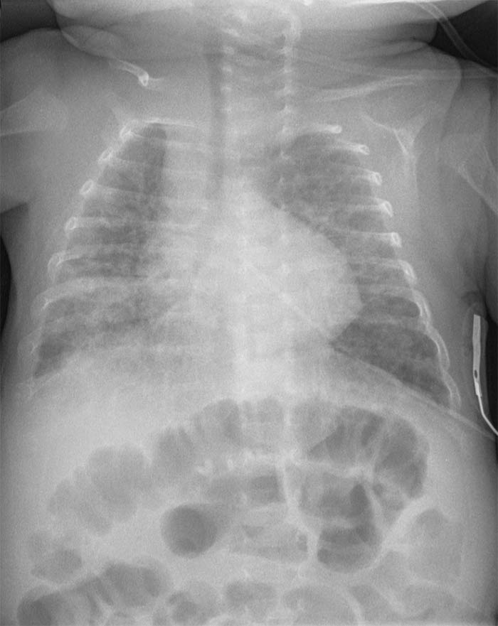 Displasia Broncopulmonar