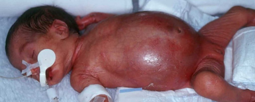 Enterocolitis Necrotizante