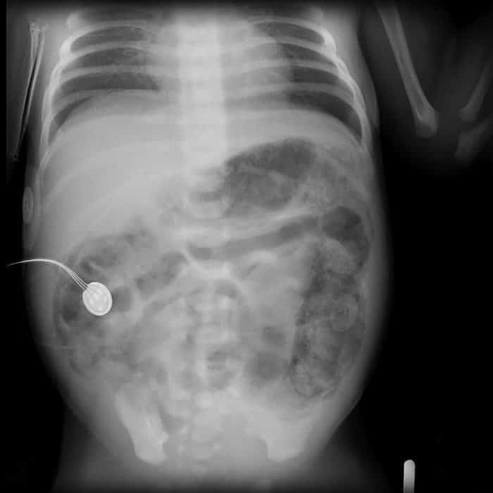 Enterocolitis necrotizante