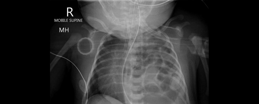 Hernia Diafragmática Congénita