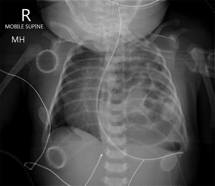 Hernia Diafragmática Congénita Rx.