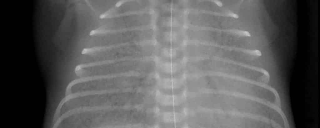 Síndrome de Dificultad Respiratoria del Recién Nacido