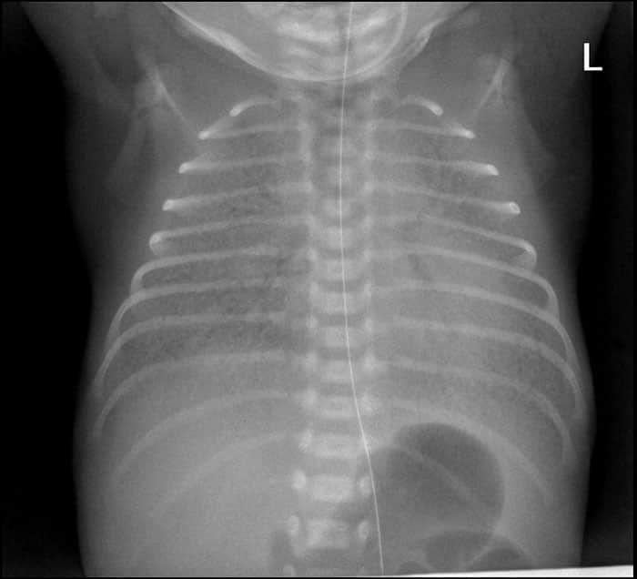 Síndrome de dificultad respiratoria del recién nacido.