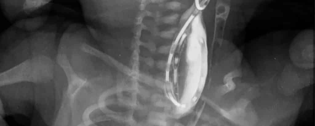 Fístula Traqueoesofágica y Atresia esofágica