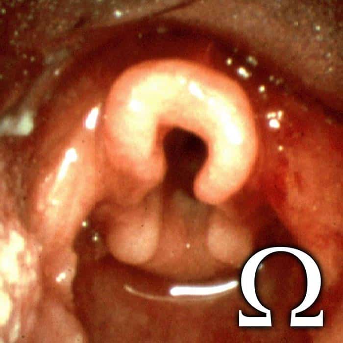 Signo del Omega en Laringomalacia