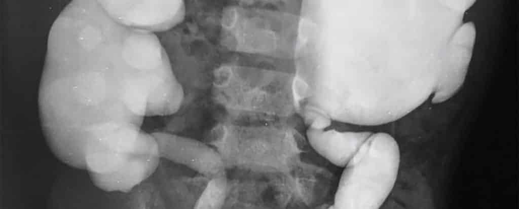 Fimosis, parafimosis, criptorquidia y Reflujo Vesicoureteral