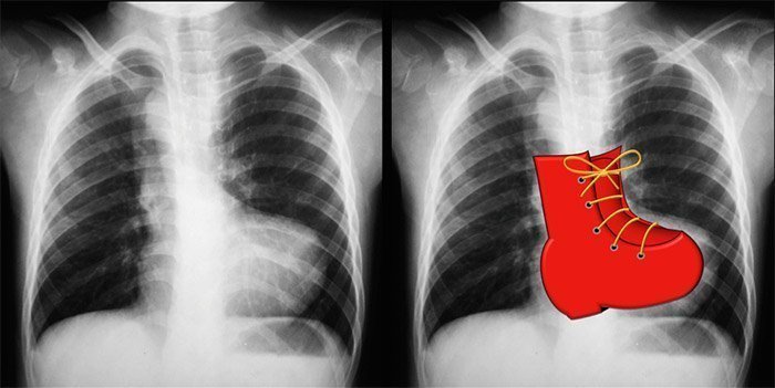 Caso de tetralogía de Fallot. El ápex cardíaco elevado sugiere un agrandamiento del ventrículo derecho. El principal segmento de la arteria pulmonar es cóncavo. Se muestra el arco aórtico del lado derecho. Hay disminución de la vascularización pulmonar (oligohemia pulmonar). Caso cortesía del Dr. Vincent Tatco, Radiopaedia.org, rID: 43059
