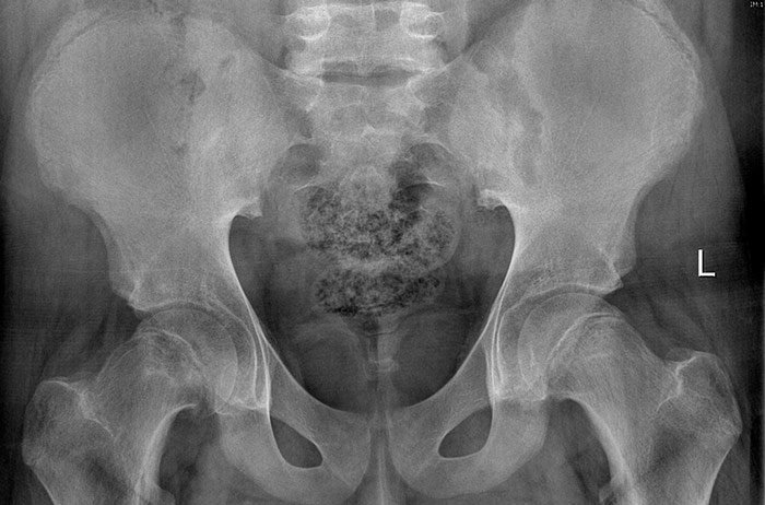 Epifisiolisis Femoral Proximal-Bilateral