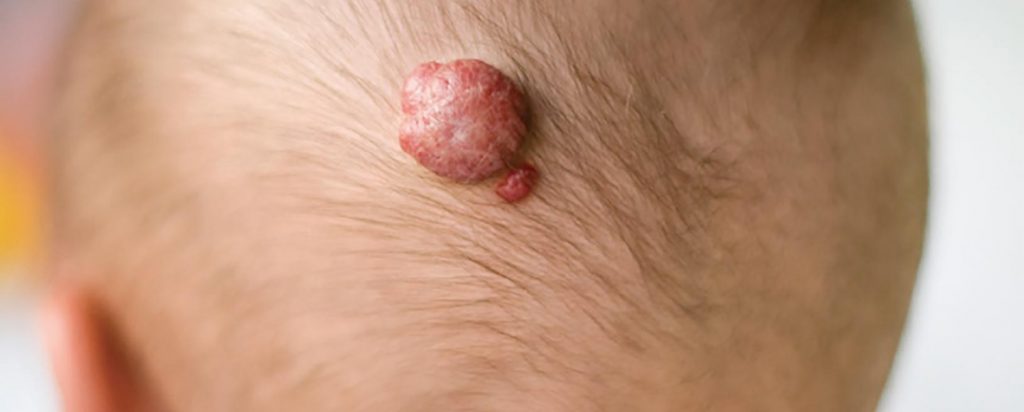 Hemangiomas en Niños