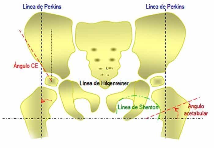 Índice Acetabular para la evaluación de la luxación congénita de cadera.