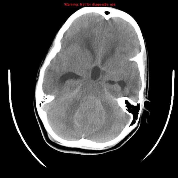 Meduloblastoma