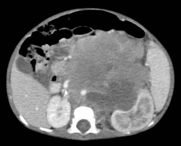 Neuroblastoma, cáncer en pediatría