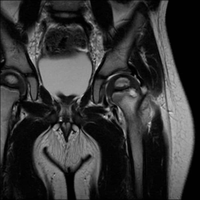 Osteomielitis en Niños