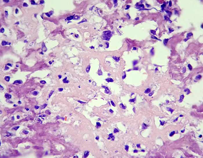 Osteosarcoma Histopatología